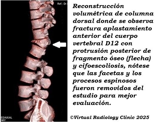 Pott disease, CT scan con recostruccion 3D