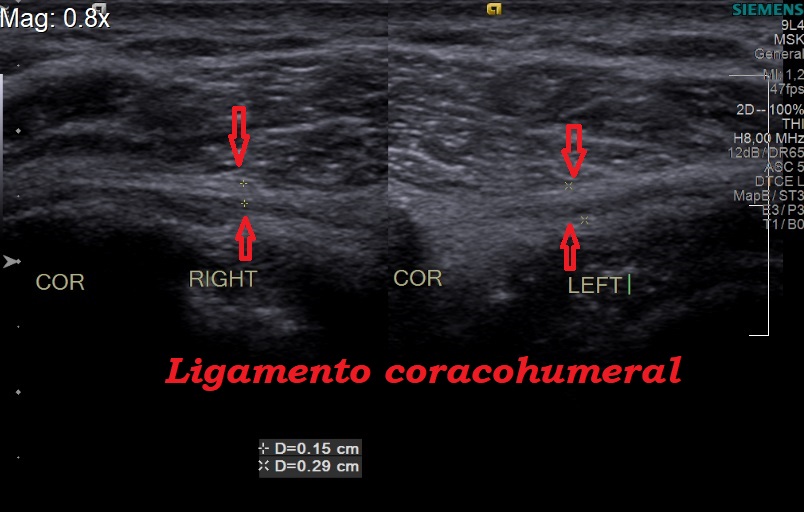 Coracohumeral ligament