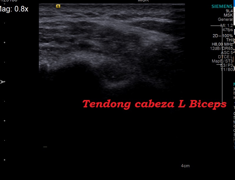 Tendon cabeza larga del biceps